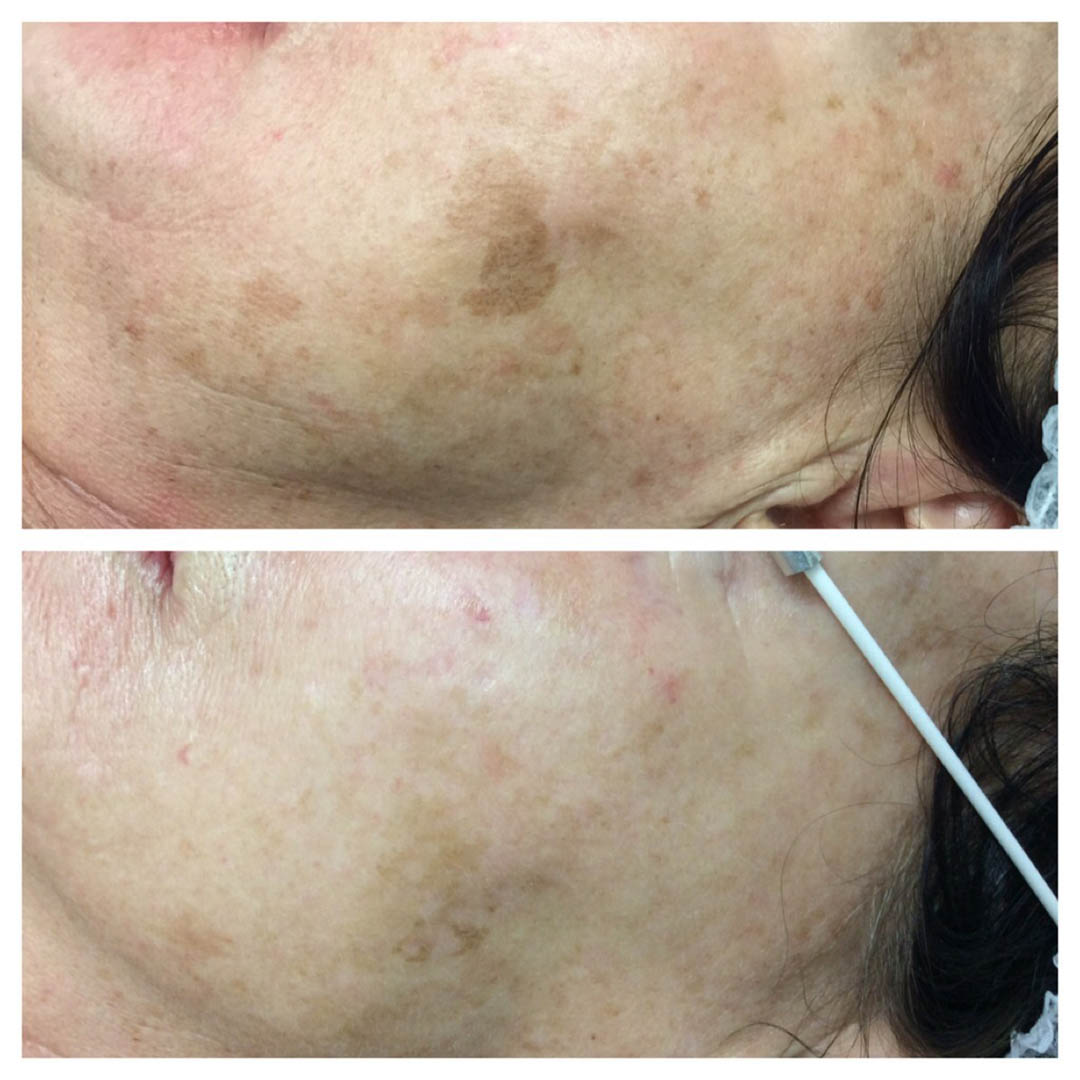 treated skin result
