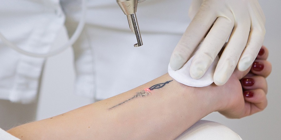Laser-Tattoo-Removal