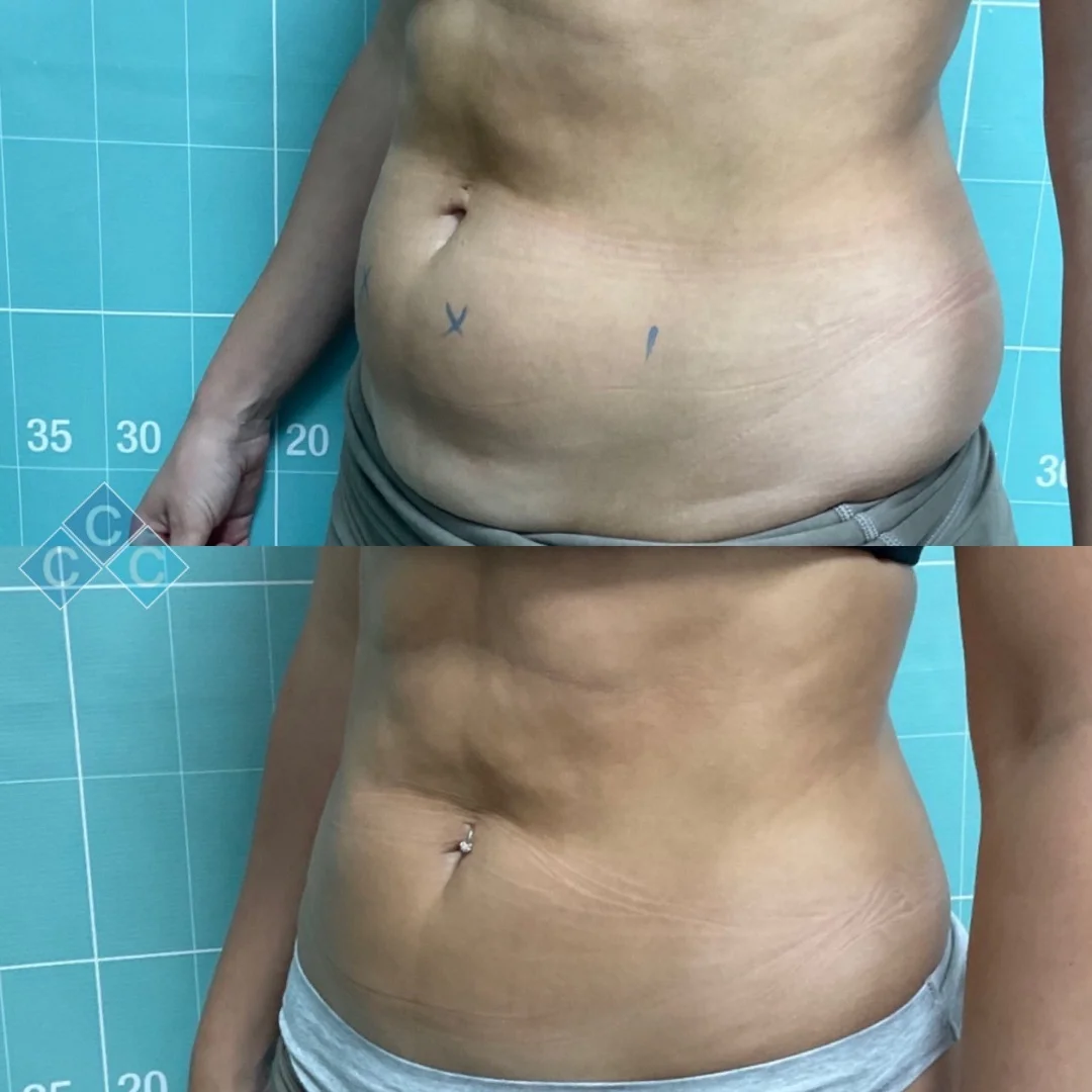 Body-Contouring