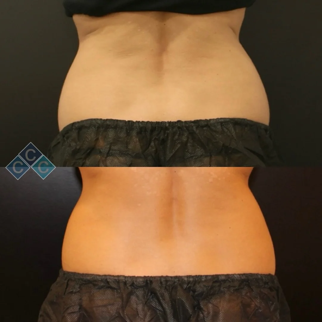 Body-Contouring