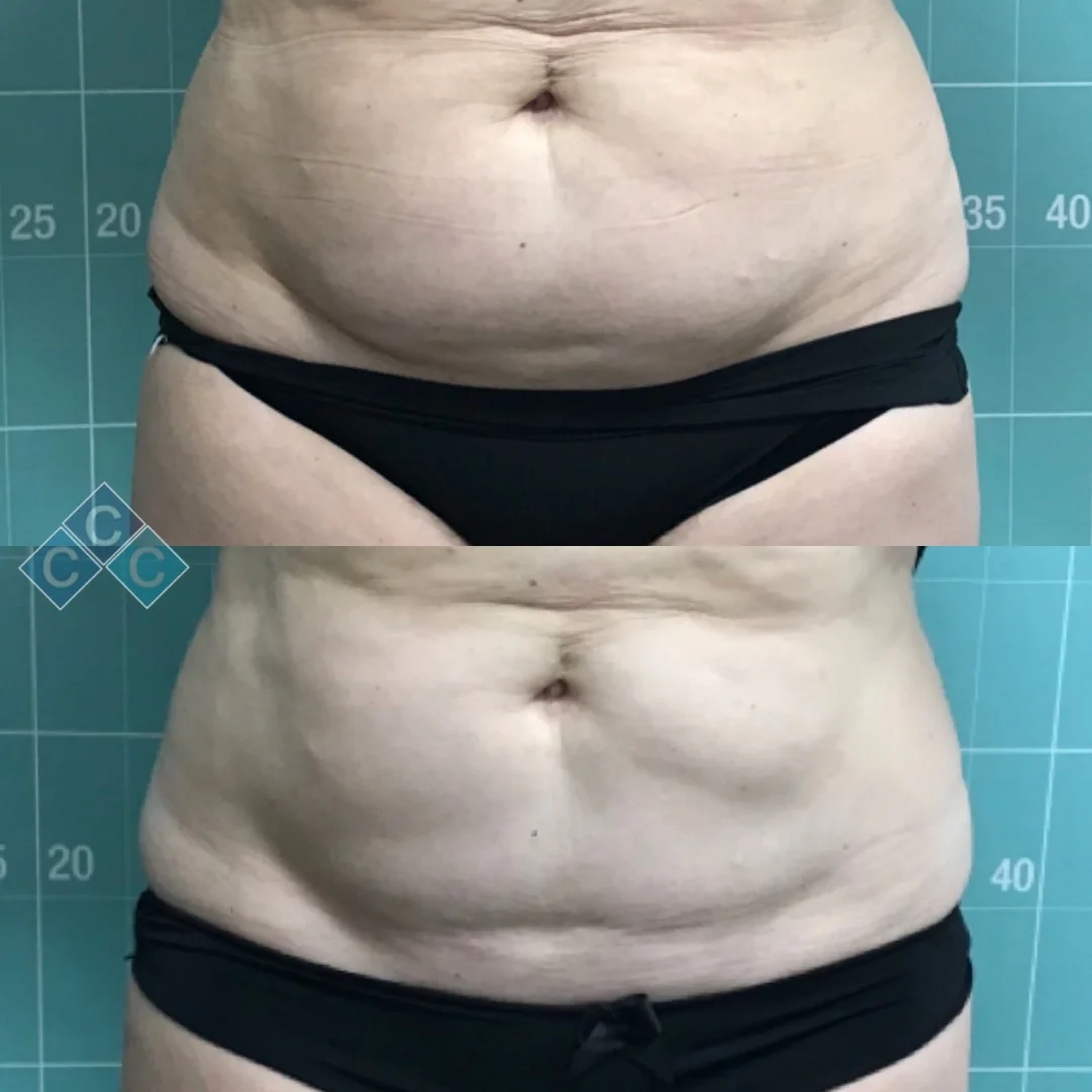 Body-Contouring