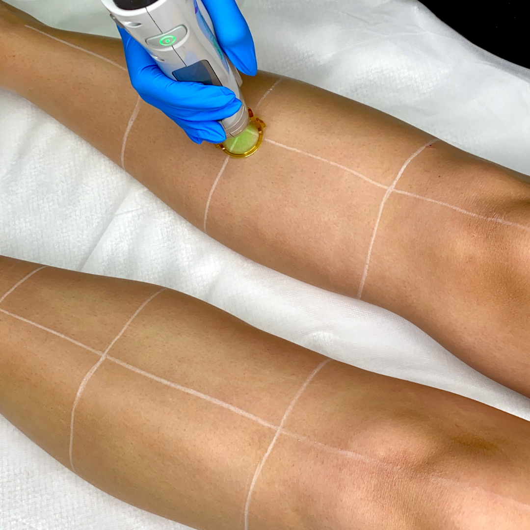 Laser Hair Removal