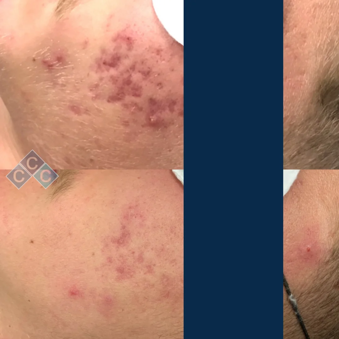 Acne-free-skin