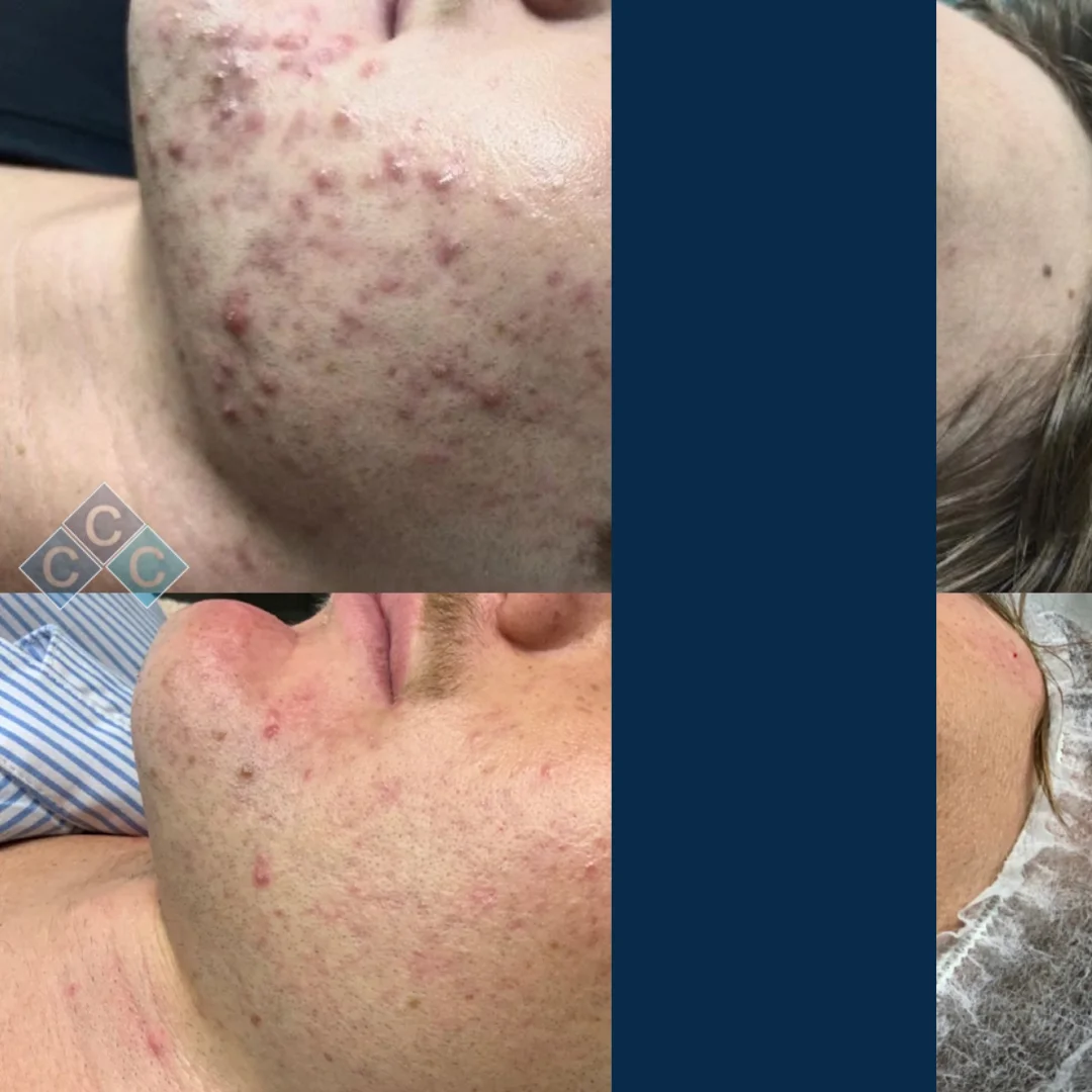 Remove-Acne