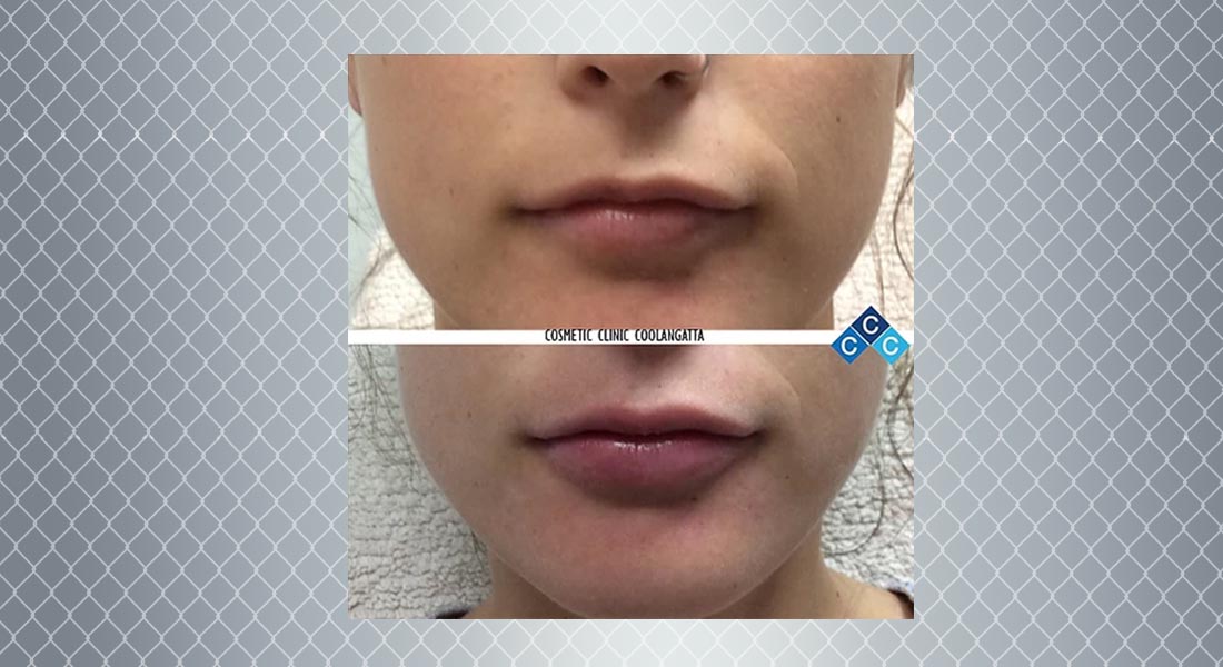 Lip-enhancement-treatment-result