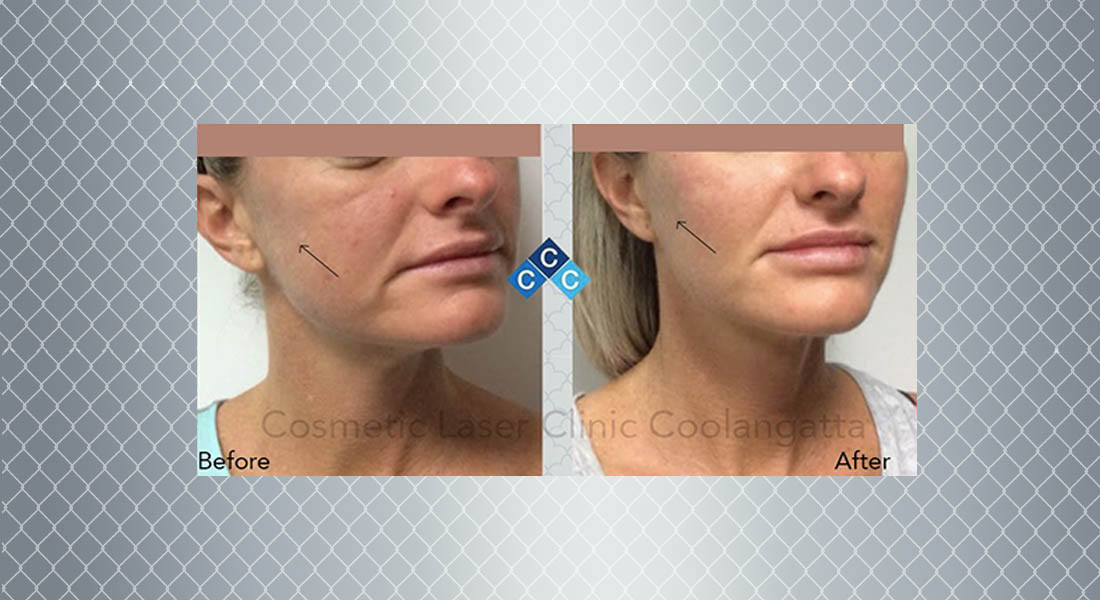 Mid Face Lift And Cheek Enhancements For Women Gold Coast