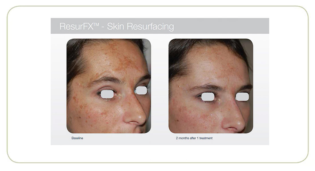 damaged-skin-resurfx-treatment-result