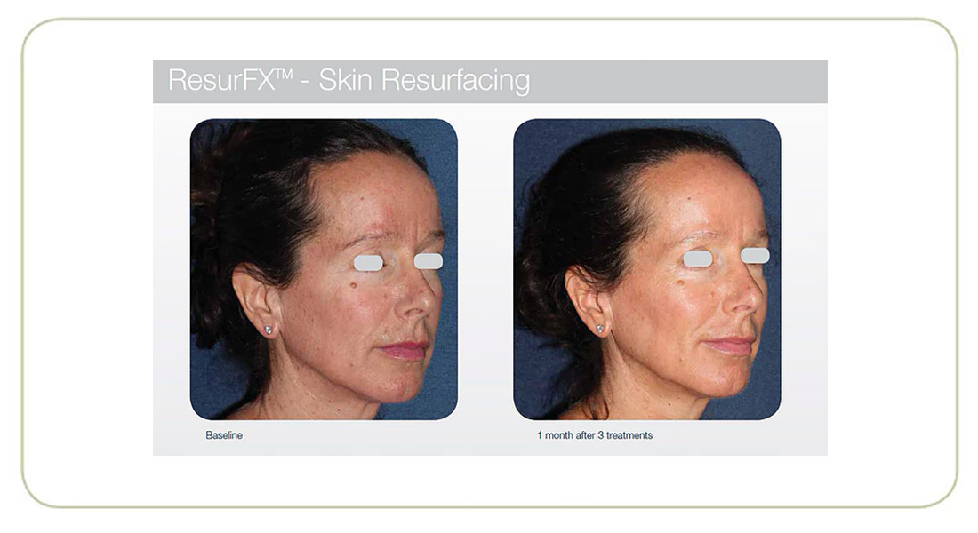 damaged-skin-resurfx-before-&-after-picture