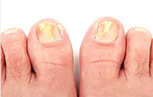 toe-nail-fungus